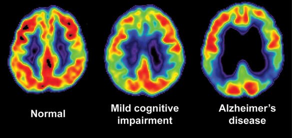 alzheimer-comparato.jpg